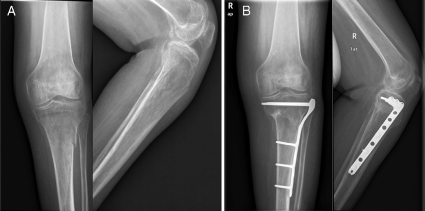 fractura rodilla